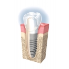 Зубная имплантация «Nobel» (США) Replace- grovy