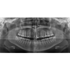 Панорамная рентгенограмма зубных рядов (ортопантомограмма)