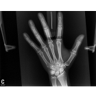 Рентгенограмма костей кисти 