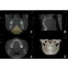 Трехмерное рентгенологическое исследование (компьютерная, конусно-лучевая томография или просто КТ) 12*8,5 см