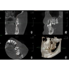 Трехмерное рентгенологическое исследование (компьютерная, конусно-лучевая томография или просто КТ) КТ 8,5*8,5 см