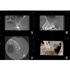 Трехмерное рентгенологическое исследование (компьютерная, конусно-лучевая томография или просто КТ) КТ 8,5*5 см