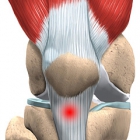 Лечение бурситов и тендинитов колена методом экстракорпоральной ударно–волновой терапии